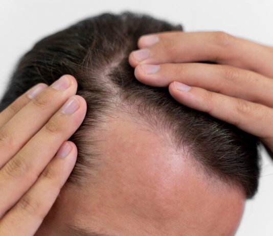 Tratamente pentru Căderea Părului la Bărbați