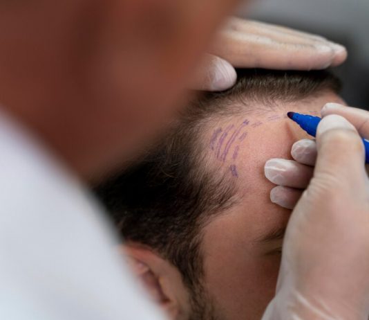 Ce să eviți după transplantul de păr în Turcia